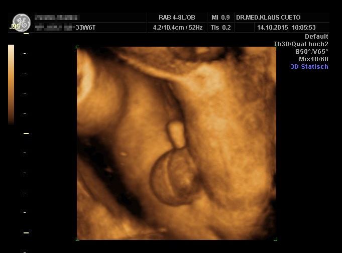 12 junge ultraschall ssw Ultraschallbild junge